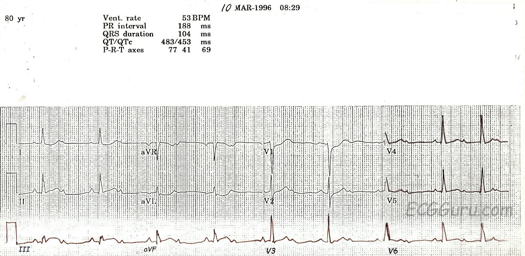 Second Degree Av Block Type I Ecg Guru Instructor Resources Second Degree Av Block Type I Ecg Guru Instructor Resources